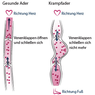 Wie entstehen Krampfadern - Dr. Ragg, Zürich